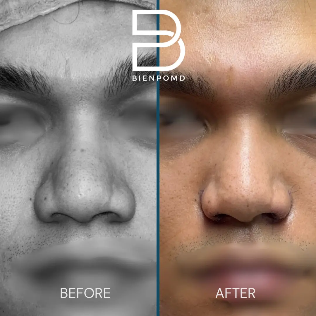 Alarplasty before and after patient result