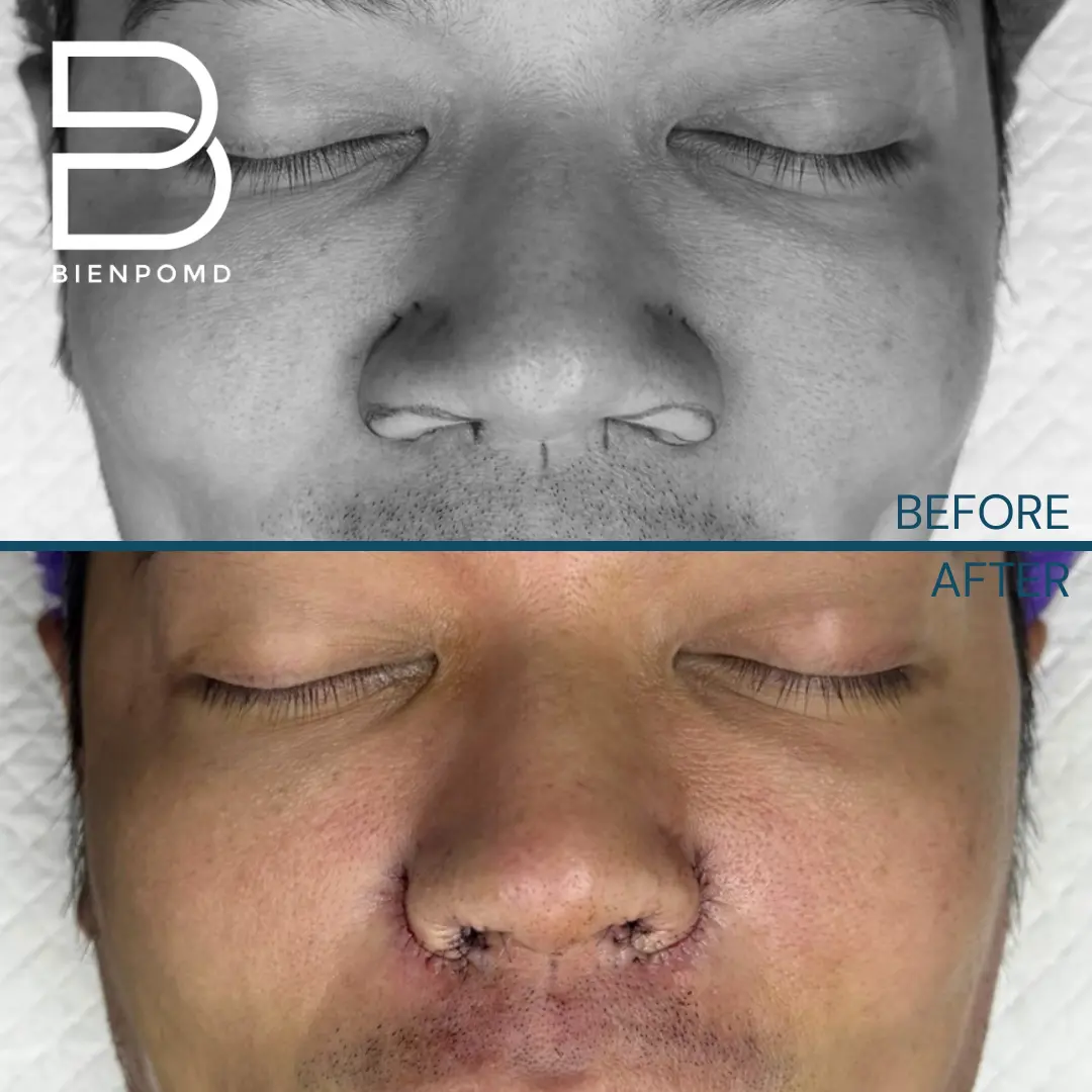 Alarplasty before and after patient result
