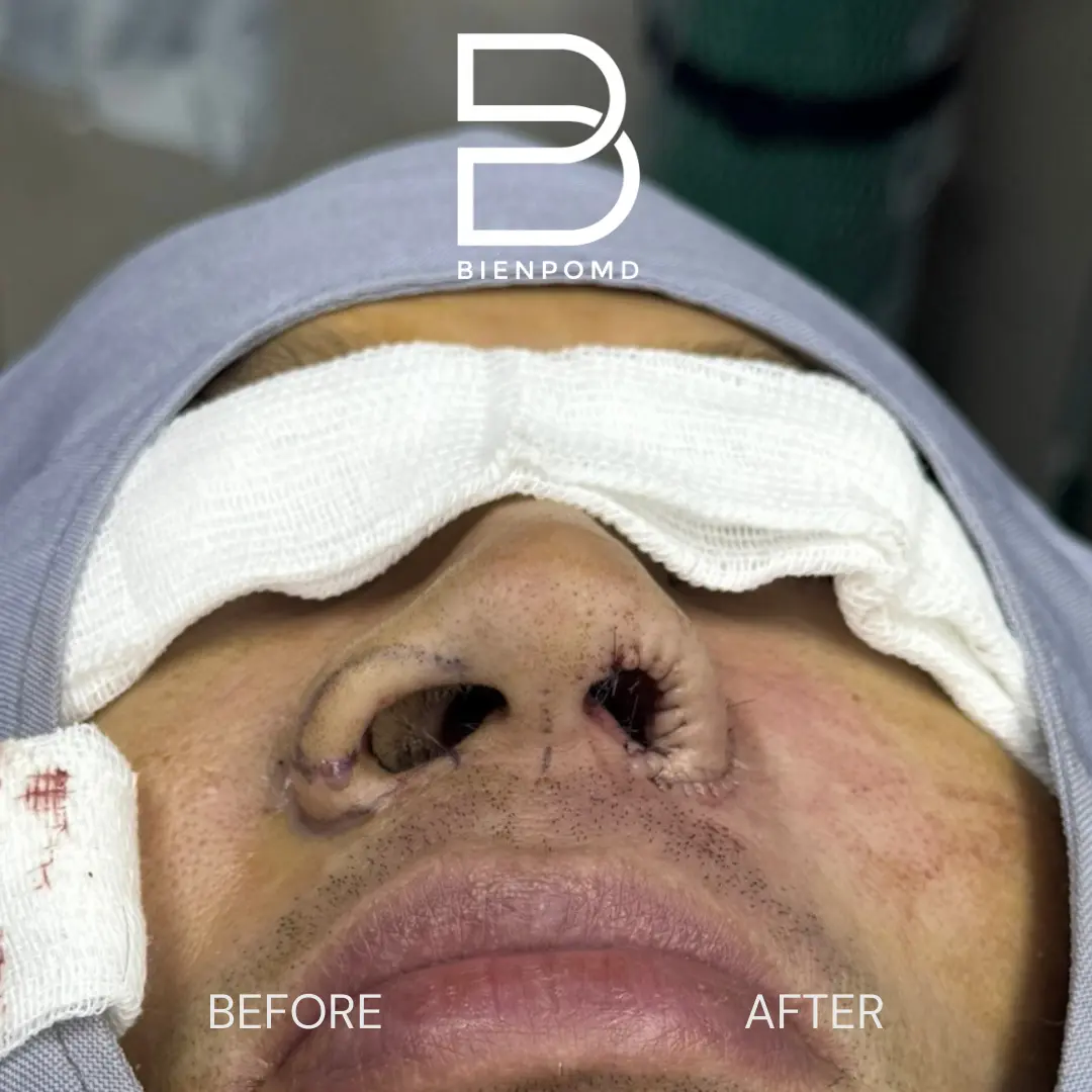Basal intraoperative Alarplasty Trifecta comparison showing the treated and untreated sides