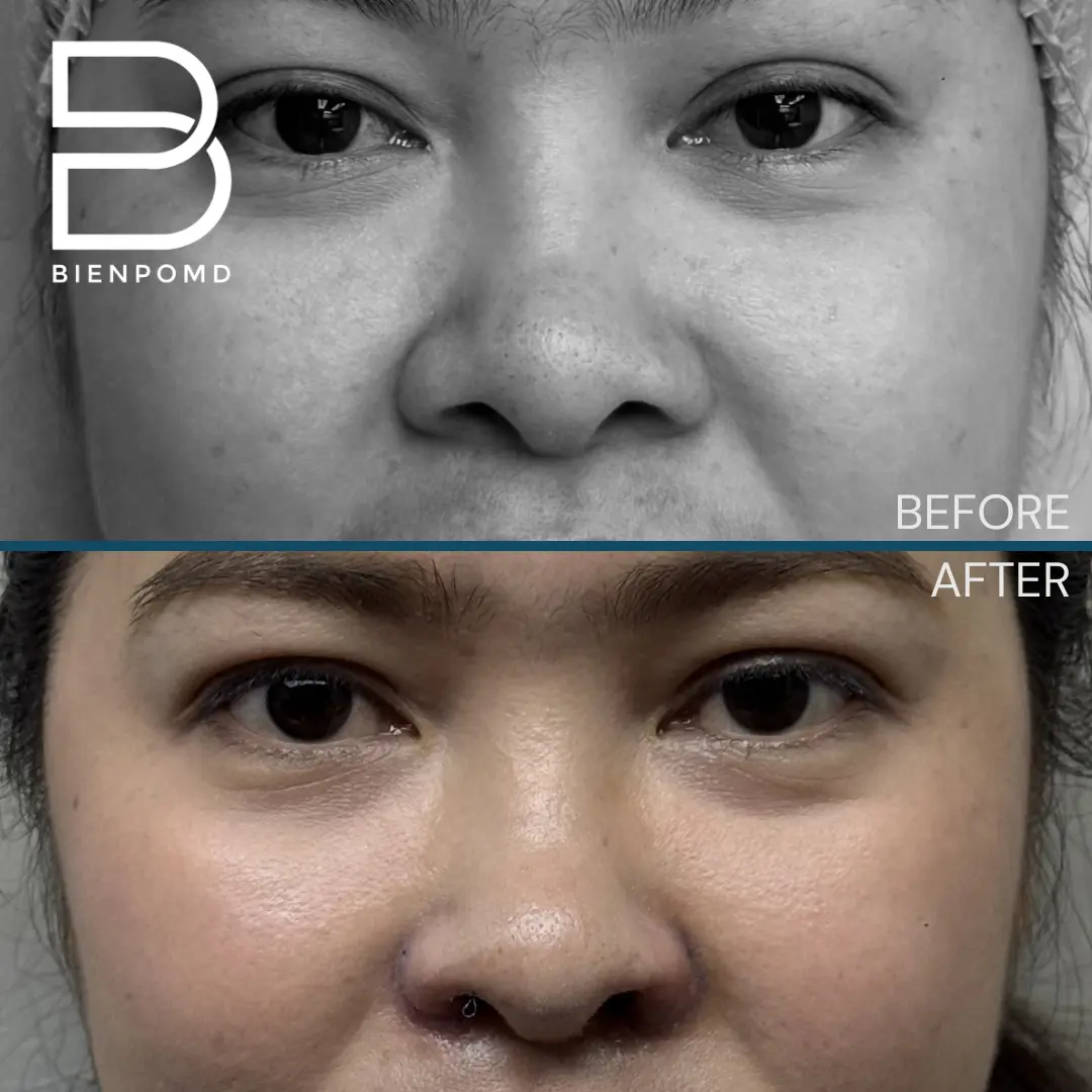 One-week transformation after Alarplasty Trifecta.