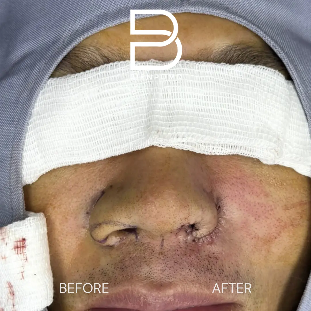 Oblique intraoperative Alarplasty Trifecta comparison showing the treated and untreated sides