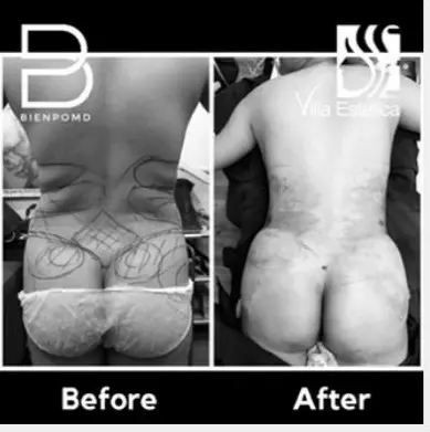 Brazilian Butt Lift before and after patient result