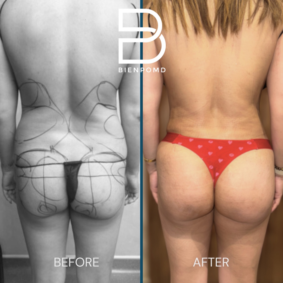 Posterior before-and-after comparison two weeks after abdominal liposuction 360 with fat graft transfer to the buttocks and hips