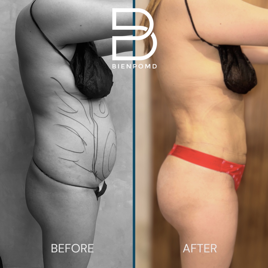Right profile before-and-after comparison two weeks after abdominal liposuction 360 with fat graft transfer to the buttocks and hips