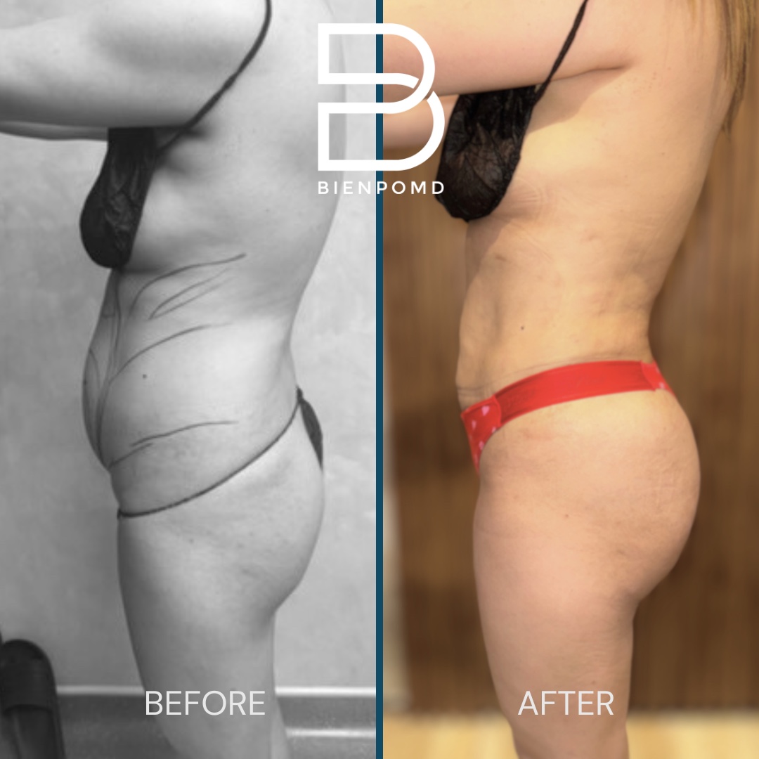Left profile before-and-after comparison two weeks after abdominal liposuction 360 with fat graft transfer to the buttocks and hips