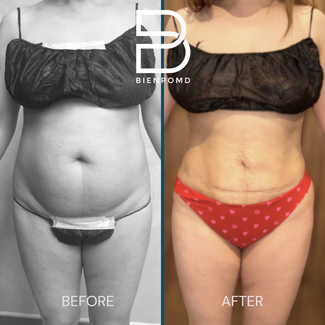 Front before-and-after comparison two weeks after abdominal liposuction 360 with fat graft transfer to the buttocks and hips