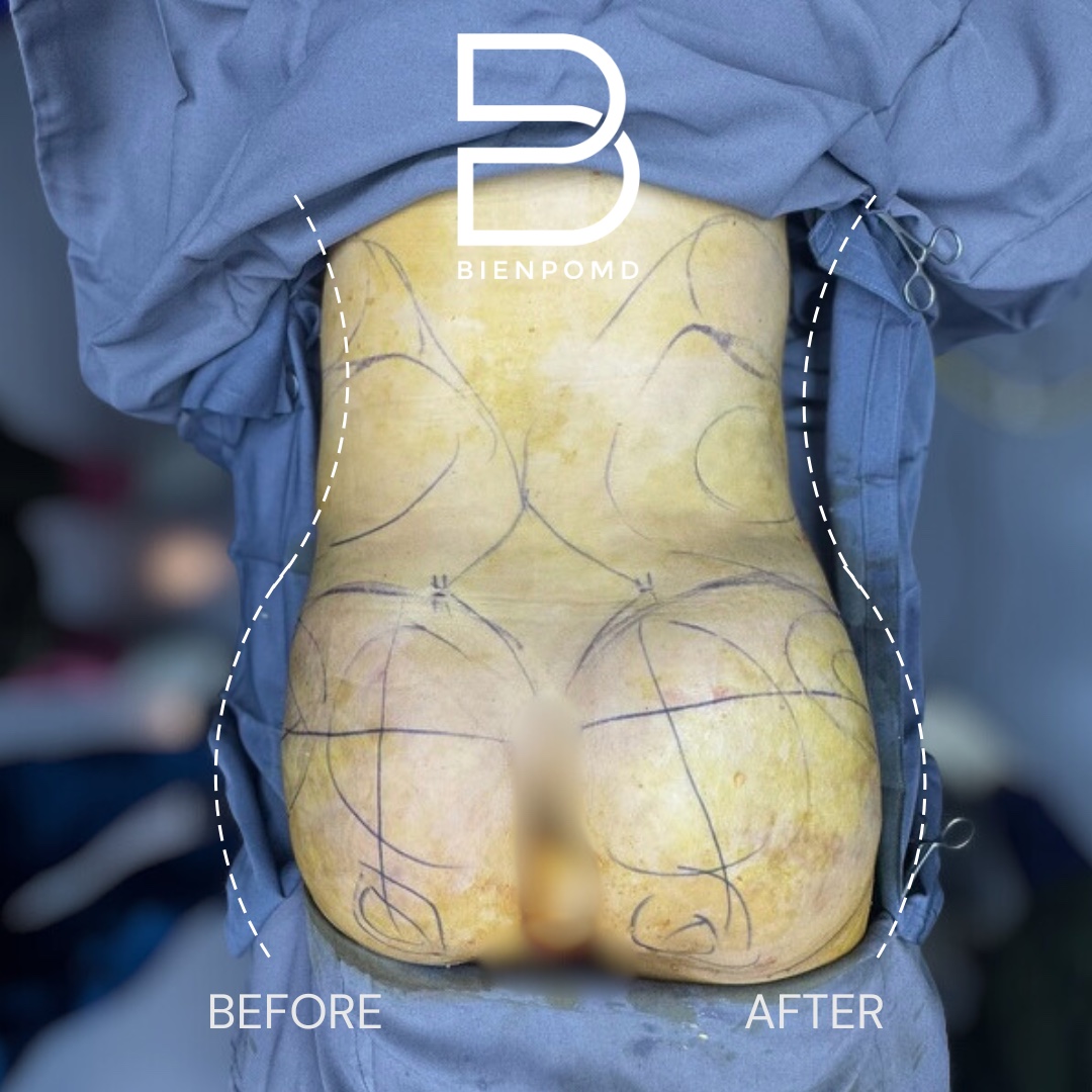 Intraoperative comparison during abdominal liposuction 360 with fat graft transfer to the buttocks and hips