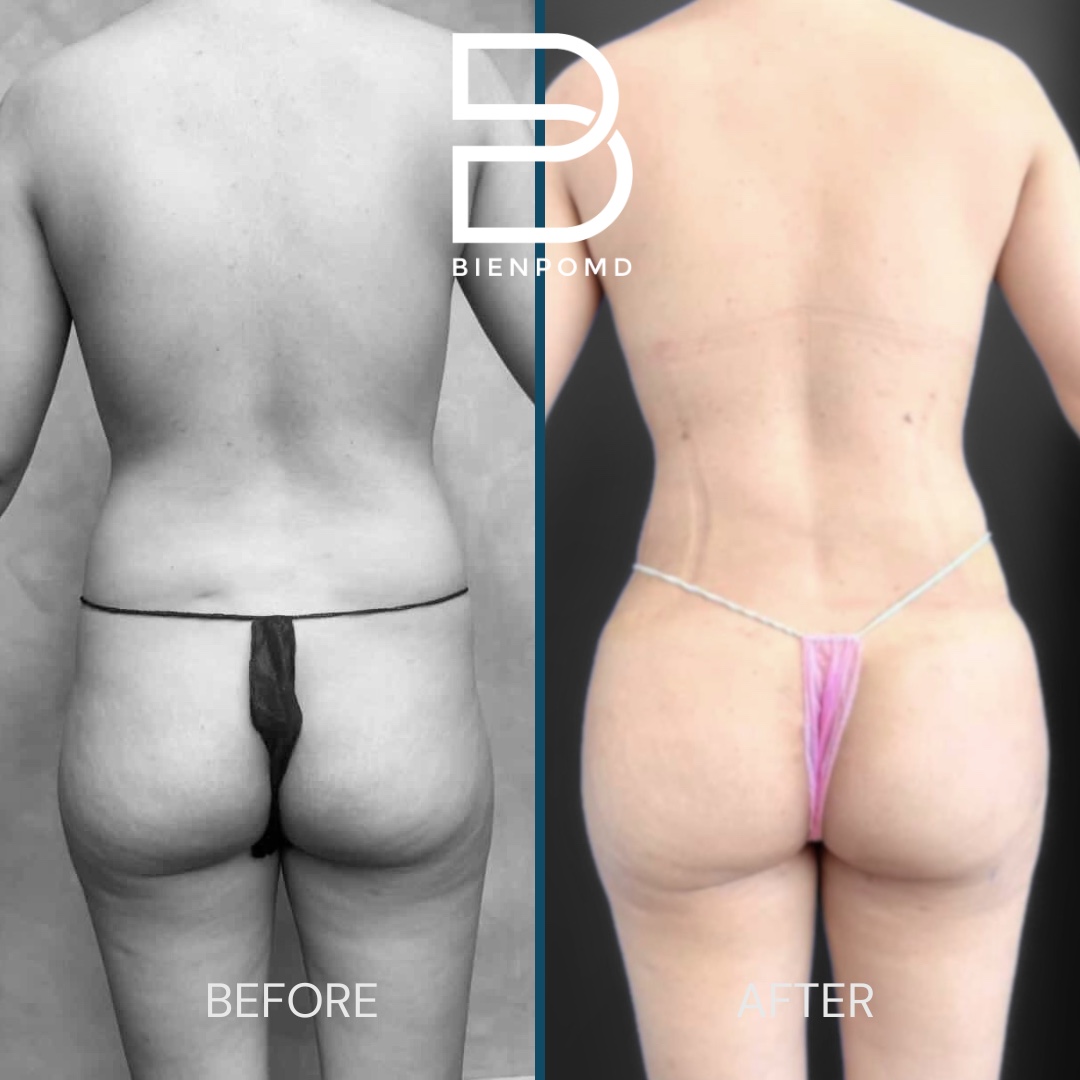 Posterior before-and-after comparison two weeks after abdominal liposuction 360 with fat graft transfer to the buttocks and hips