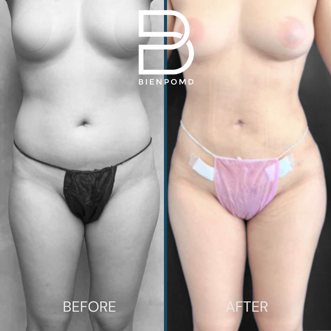 Front before-and-after comparison two weeks after abdominal liposuction 360 with fat graft transfer to the buttocks and hips