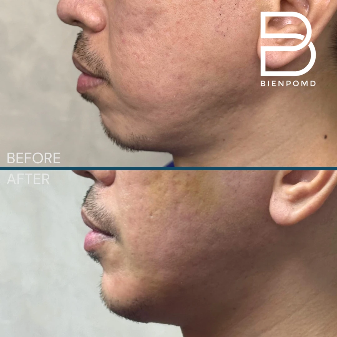 Chin Augmentation before and after patient result