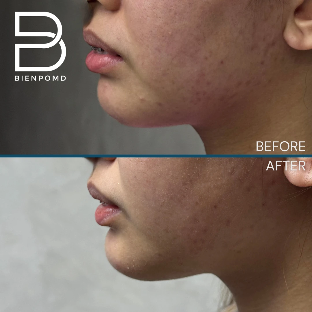 One-week transformation after Chin Augmentation.