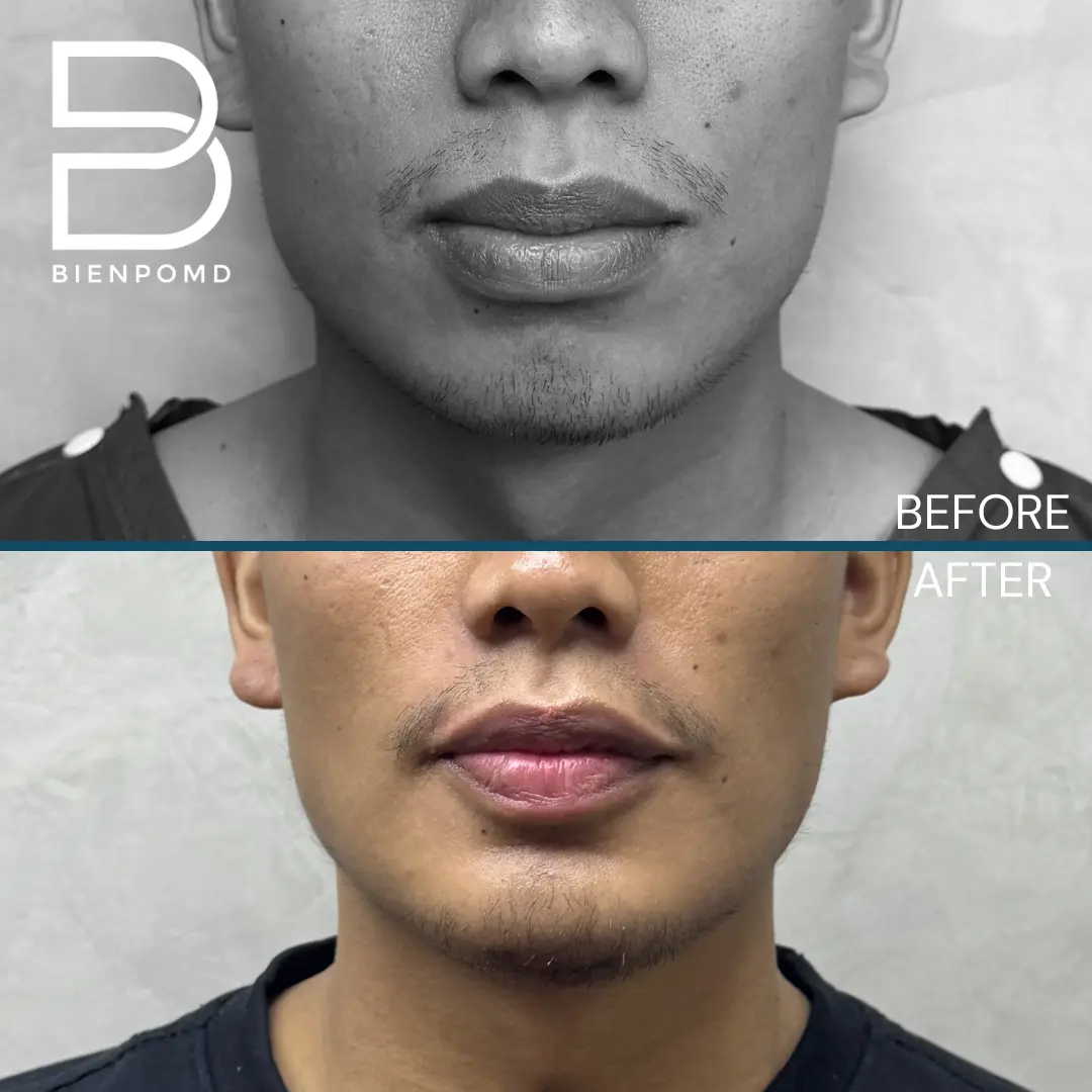 Chin augmentation before-and-after comparison, view 1