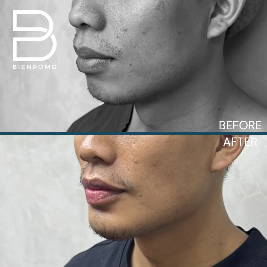 Chin augmentation before-and-after comparison, view 3