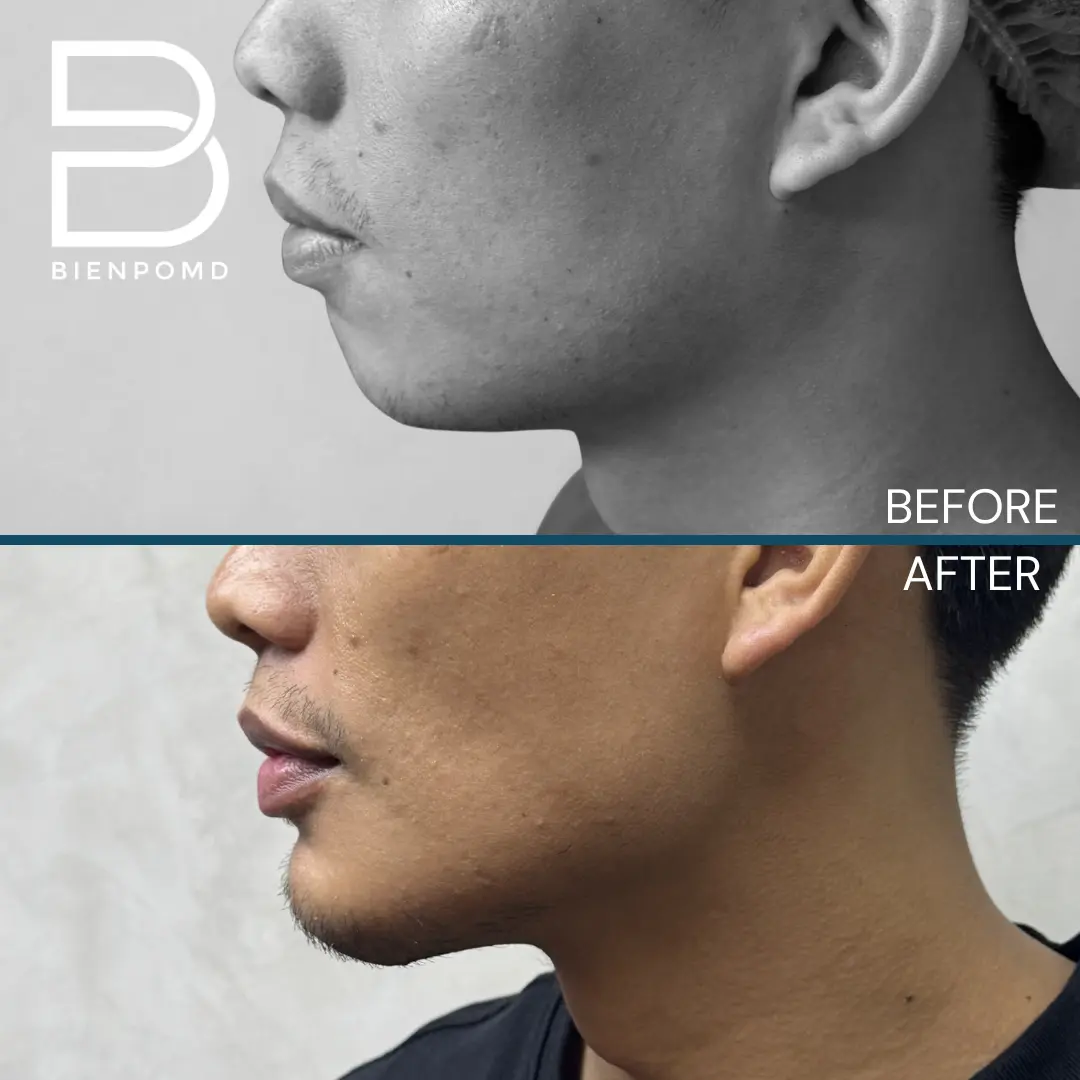 Chin augmentation before-and-after comparison, view 4