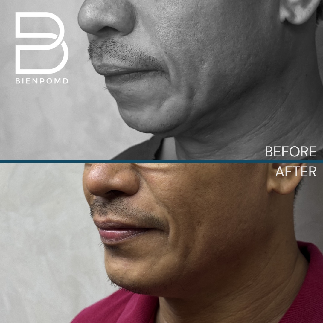 One week transformation after chin implant surgery using a large implant, shown from the left profile