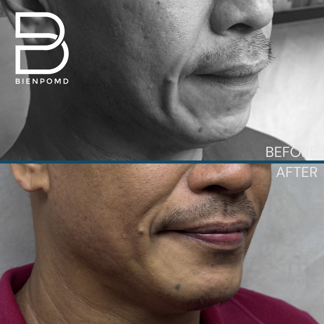 One week transformation after chin implant surgery using a large implant, shown from the right profile