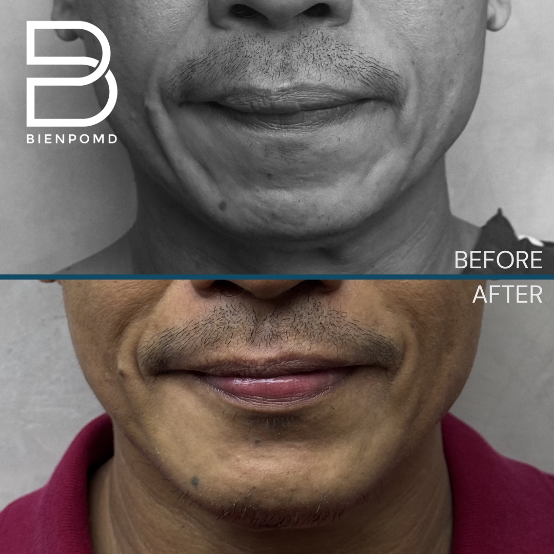 One week transformation after chin implant surgery using a large implant, shown from the front