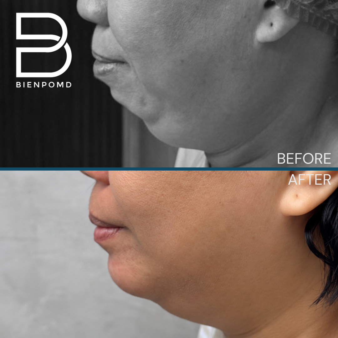 Before and 1 week after chin augmentation with a large silicone implant — view 1. This is an early healing result; individual results vary.