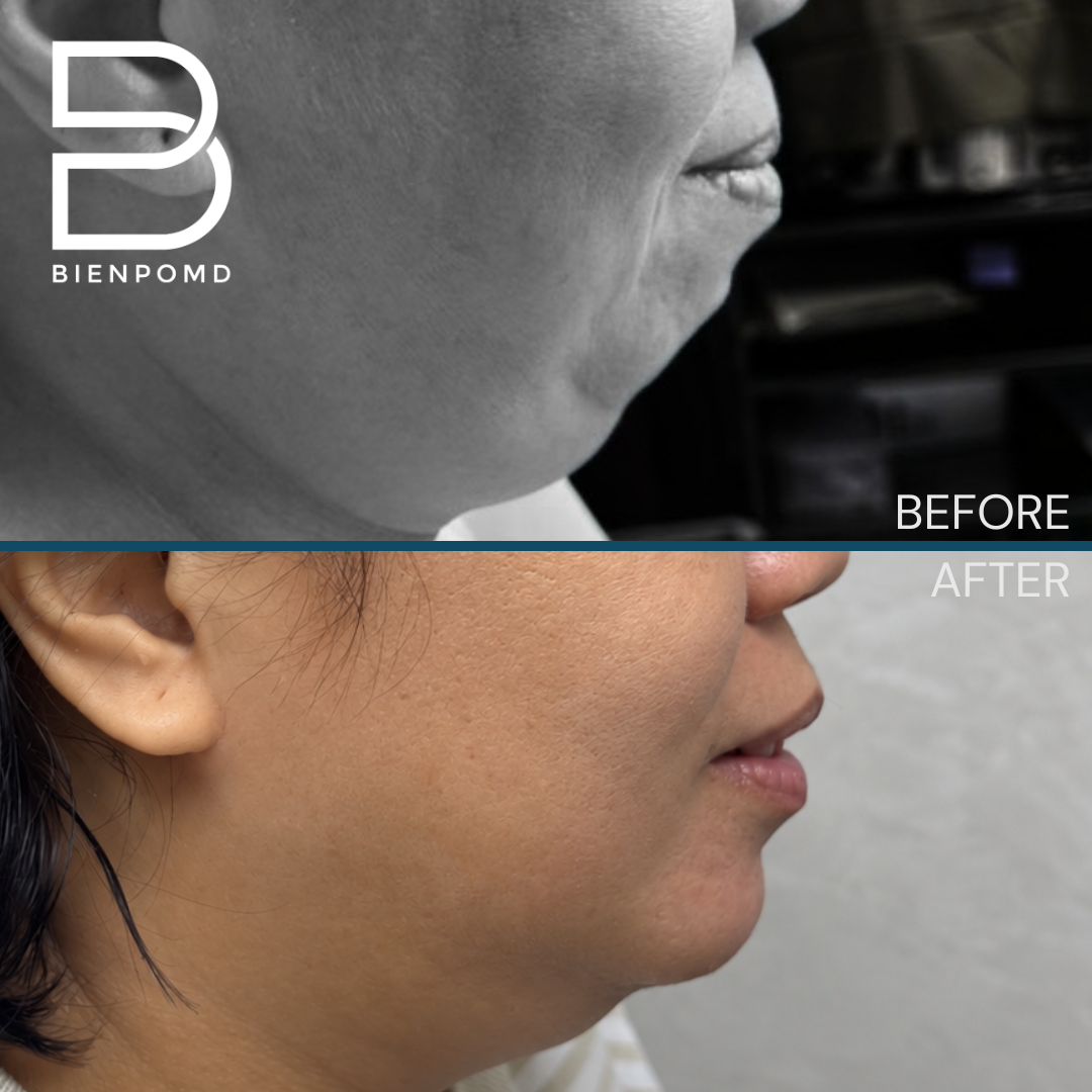 Before and 1 week after chin augmentation with a large silicone implant — view 2. This is an early healing result; individual results vary.