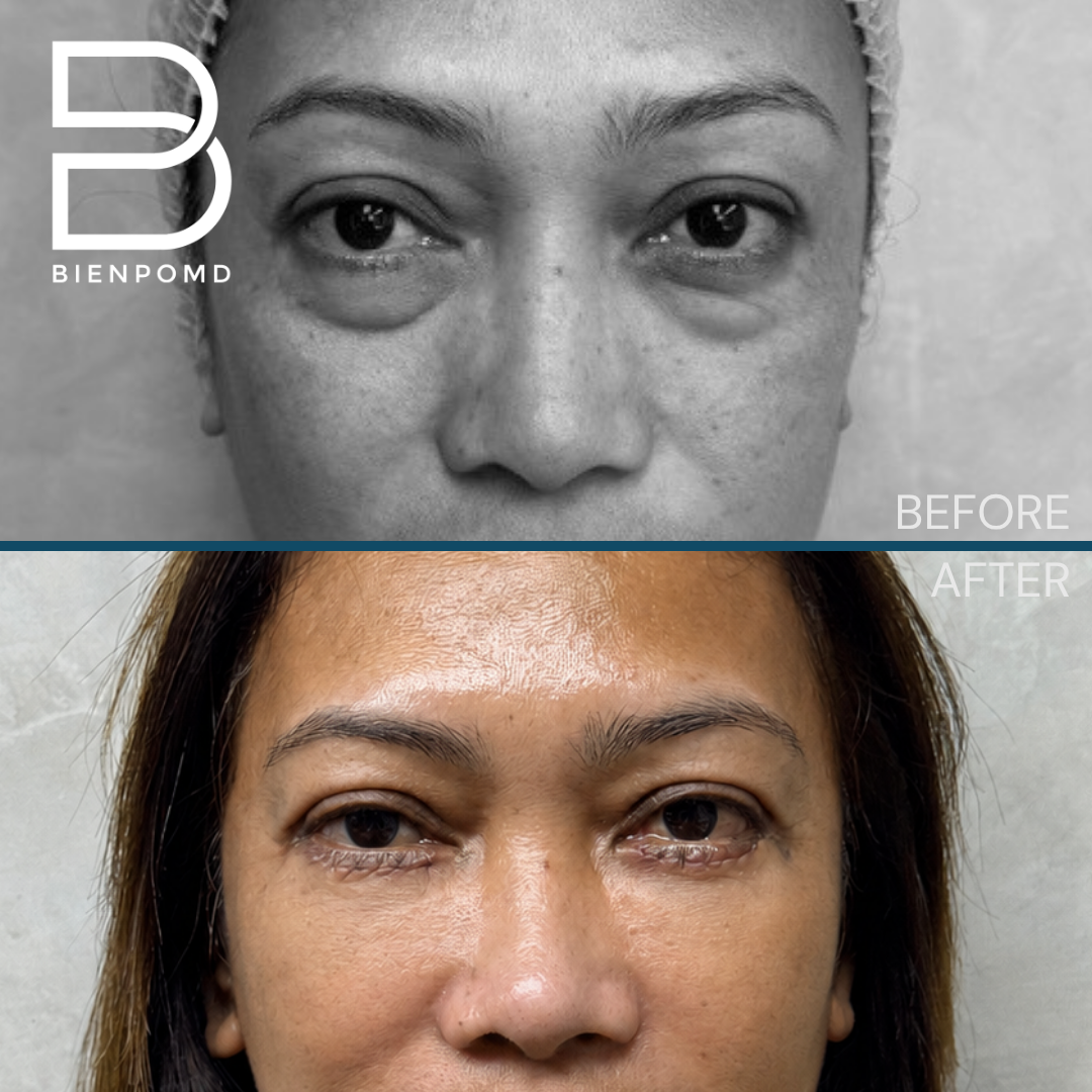 Before and one week after lower blepharoplasty combined with under-eye fat graft transfer using microfat and nanofat