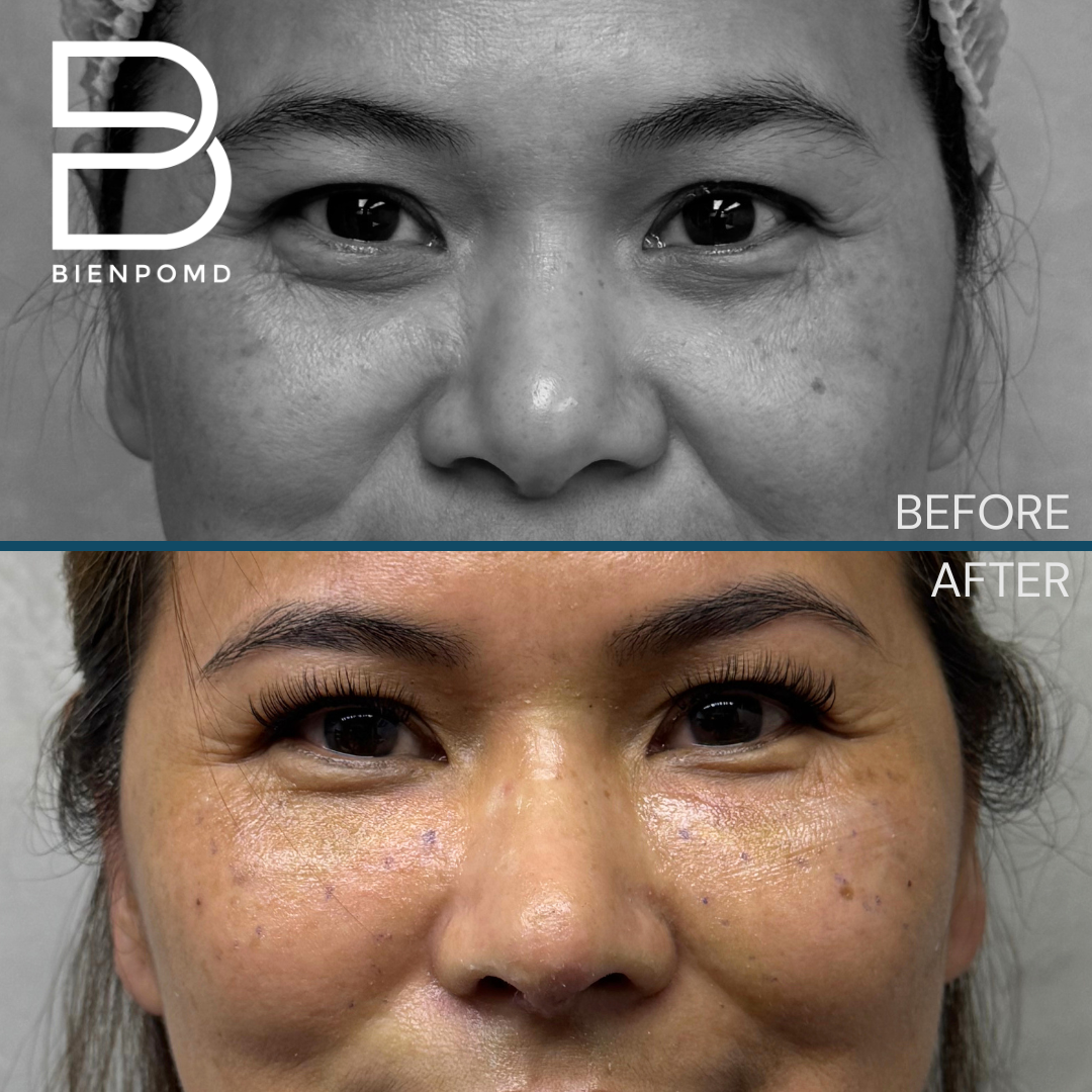 Front view before and one week after Tipplasty using irradiated rib and conchal cartilage combined with under-eye fat graft transfer