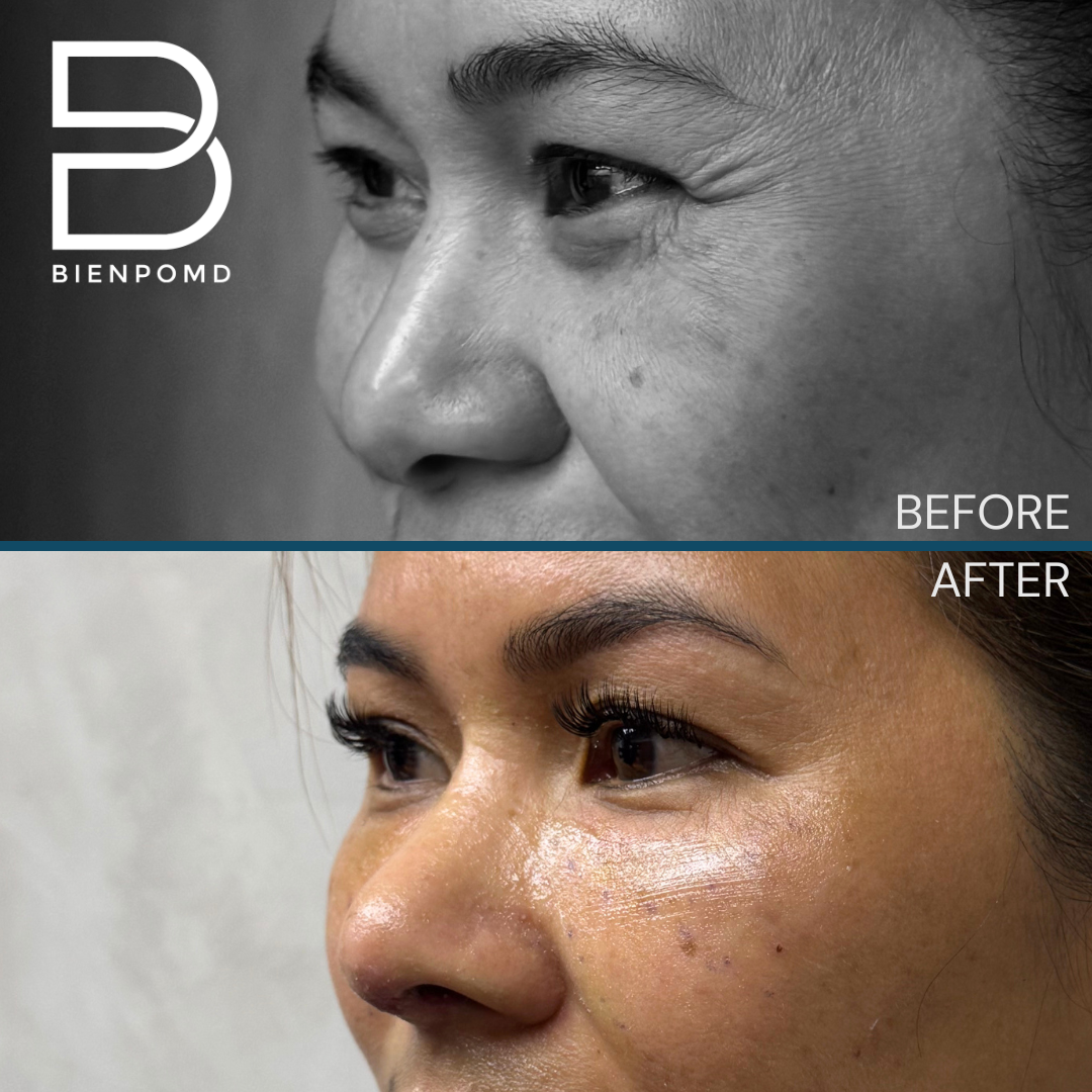 Left oblique view before and one week after Tipplasty using irradiated rib and conchal cartilage combined with under-eye fat graft transfer
