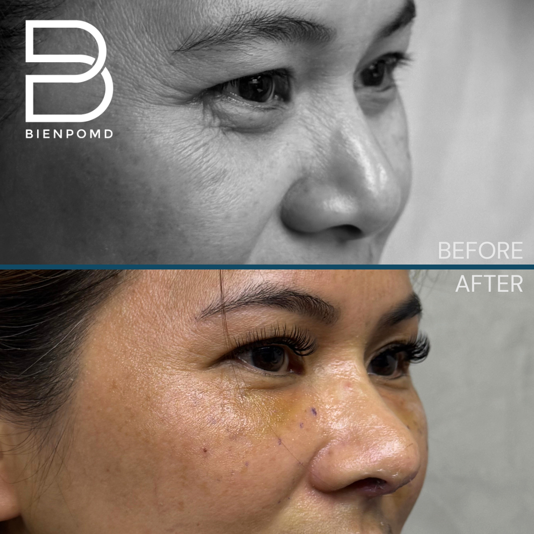 Right oblique view before and one week after Tipplasty using irradiated rib and conchal cartilage combined with under-eye fat graft transfer