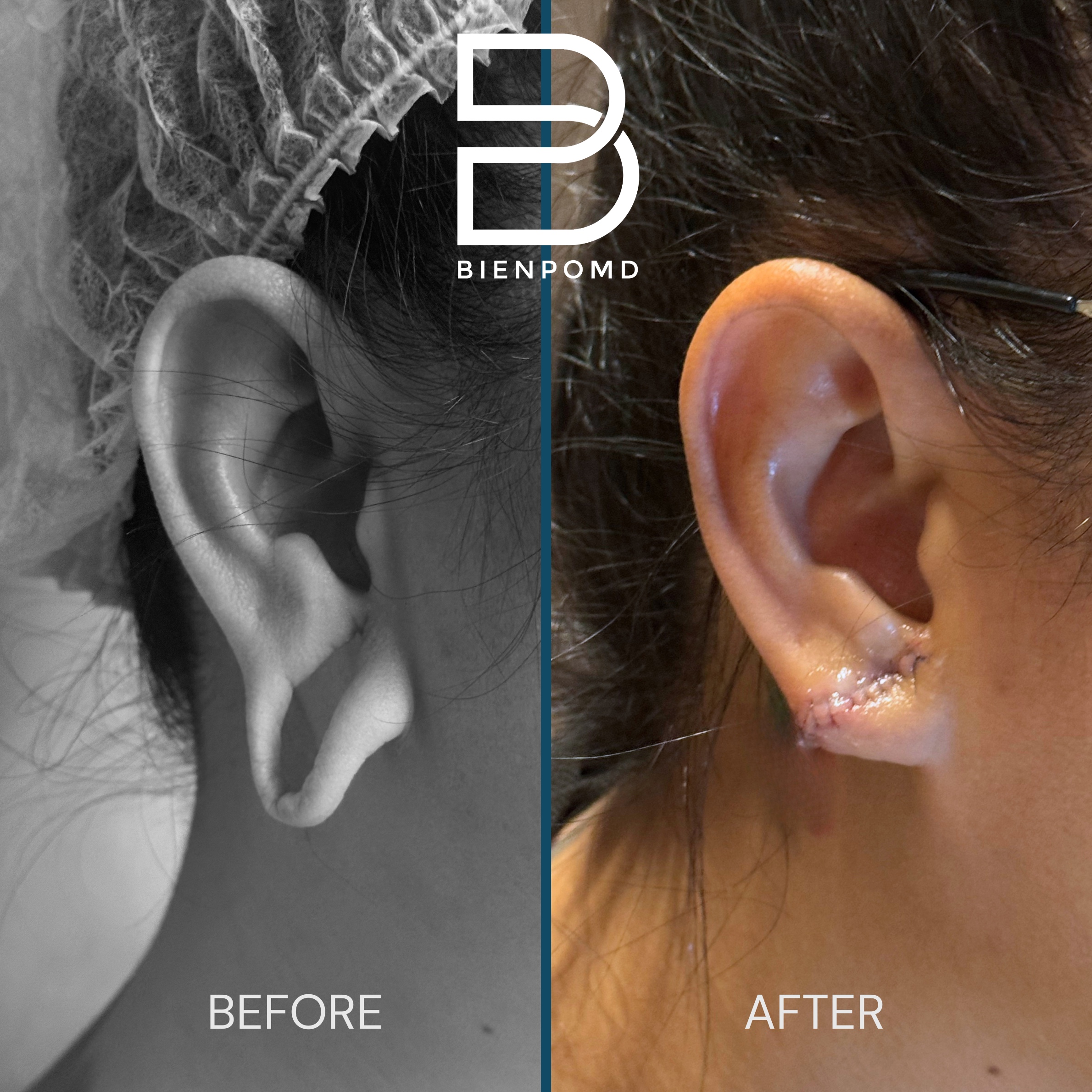 One-week before and after result following earlobe repair for a longstanding tunnel piercing