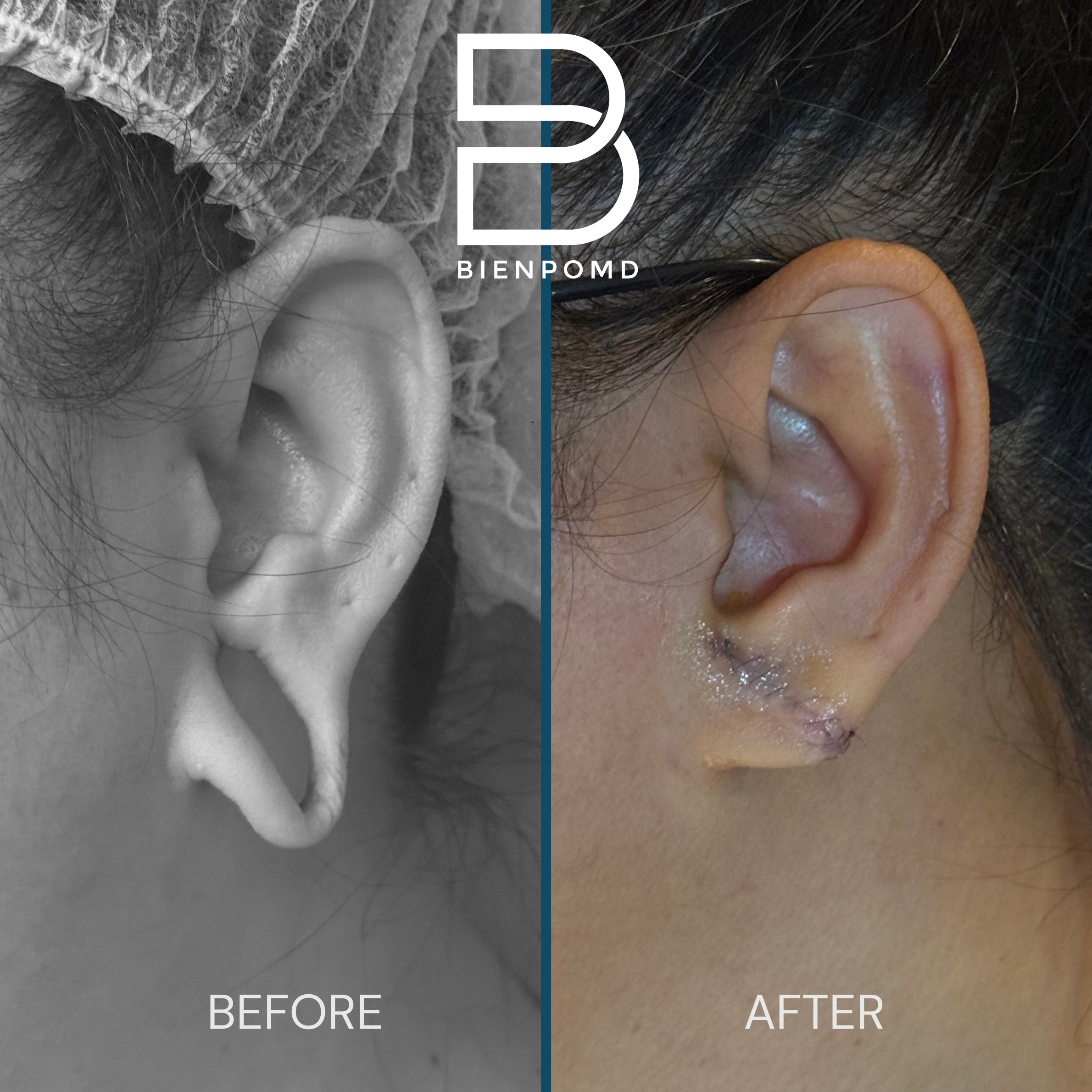 Earlobe Repair — One-Week Early Result