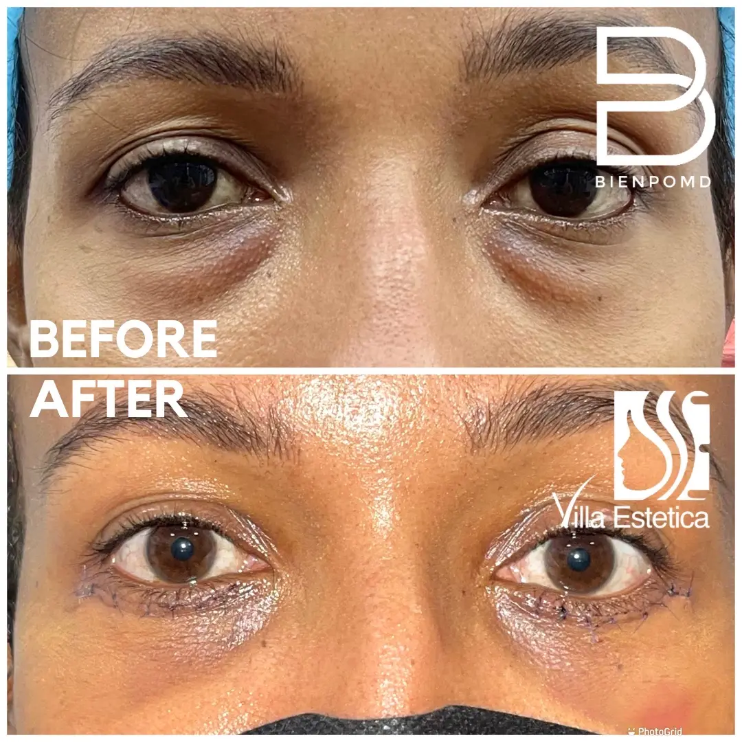 Eyebag Surgery before and after patient result