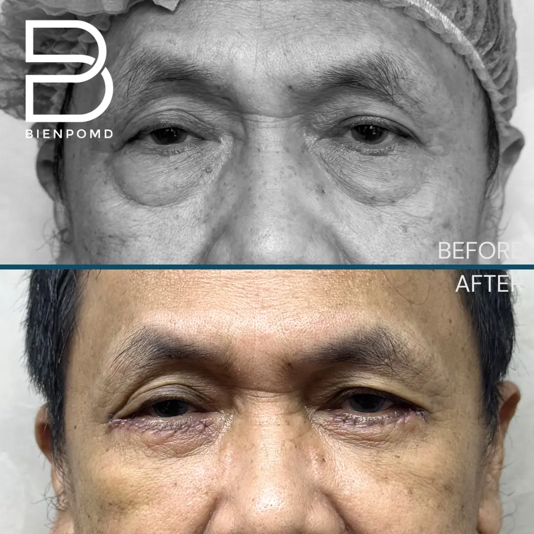 Eyebag Surgery before and after patient result