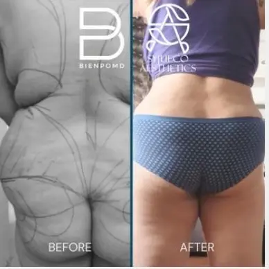 Fat Graft & Transfer before and after patient result