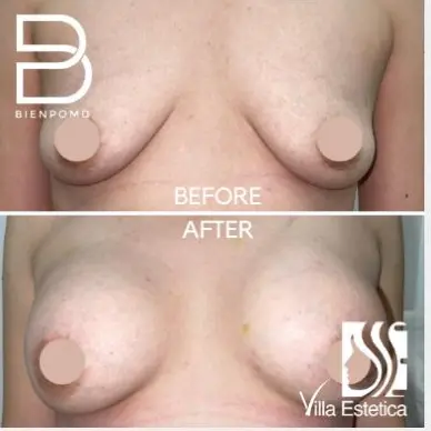 Fat Graft & Transfer published patient result