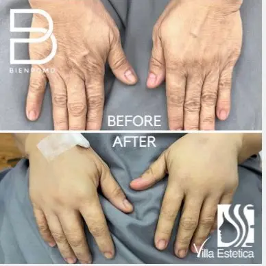 Fat Graft & Transfer published patient result