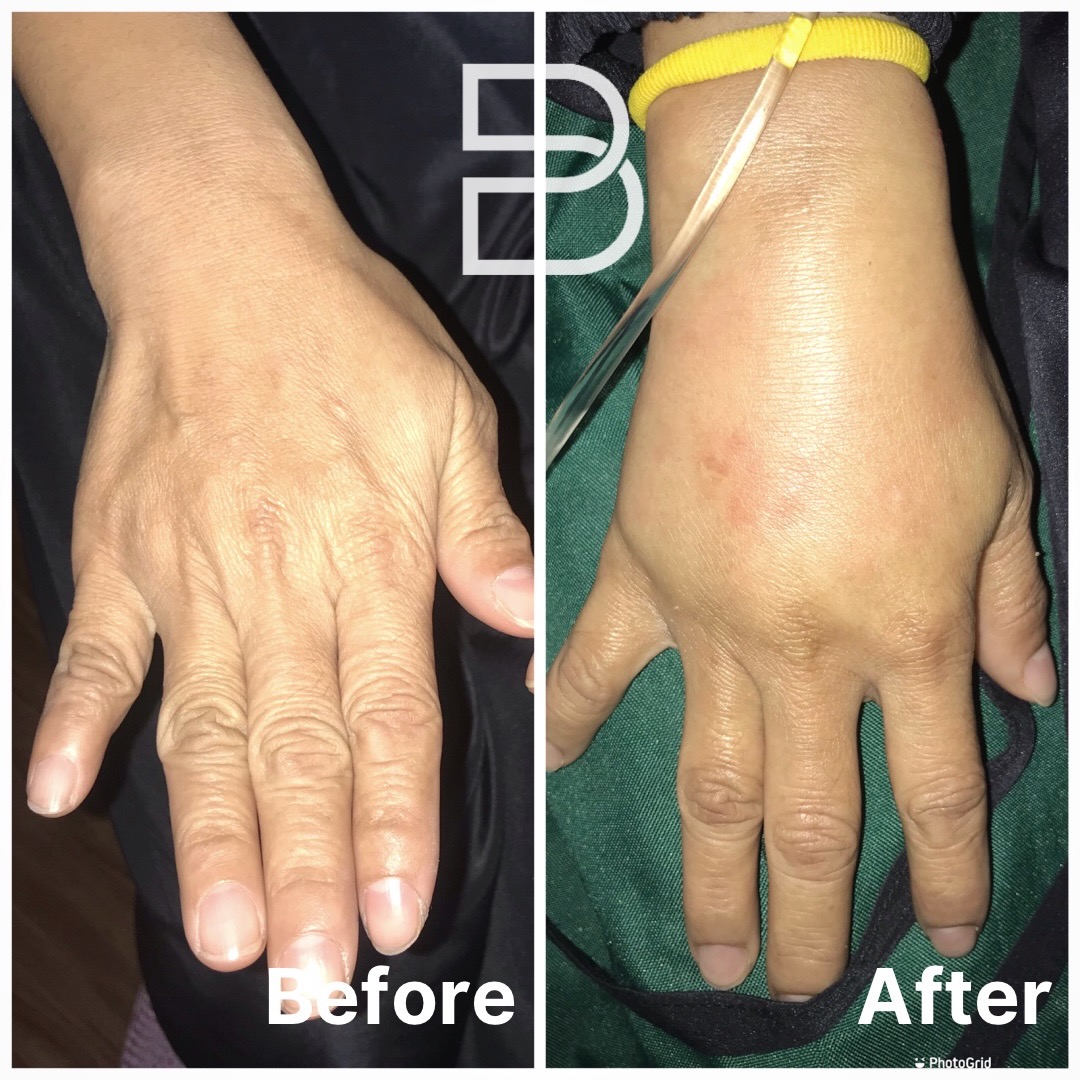Hand rejuvenation with fat grafting patient result