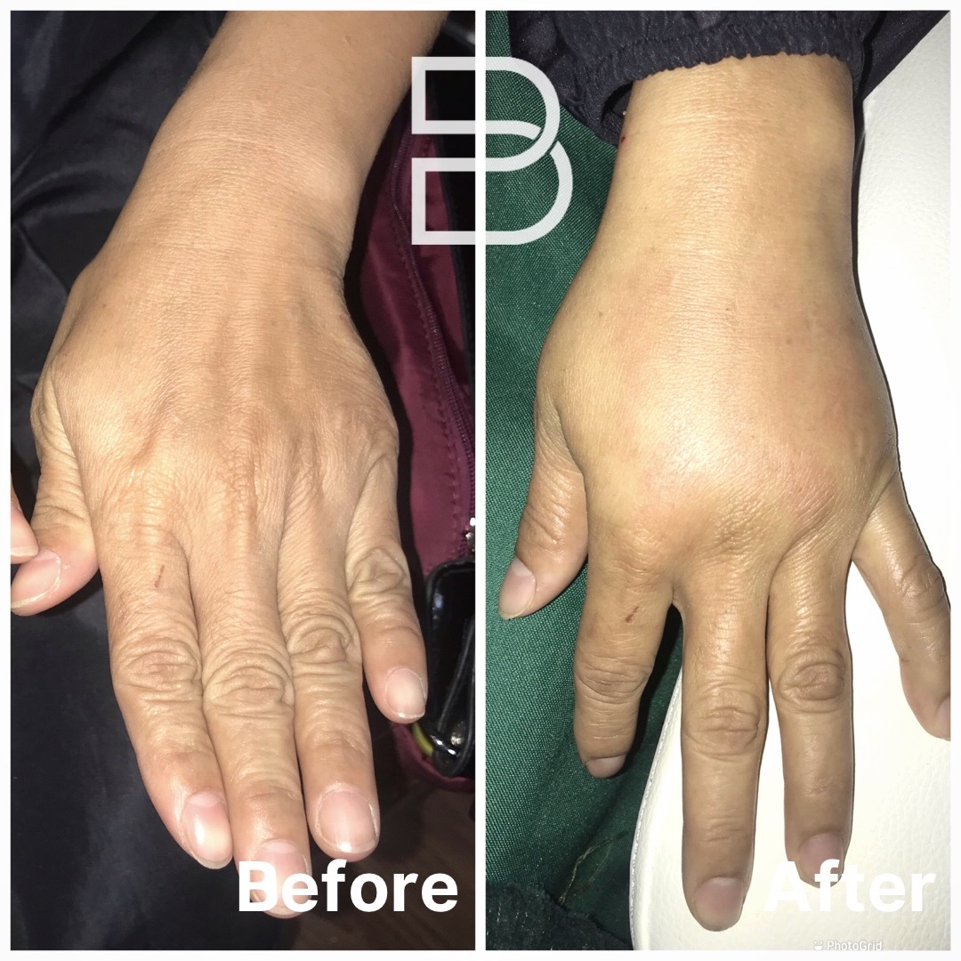 Hand rejuvenation with fat grafting patient result