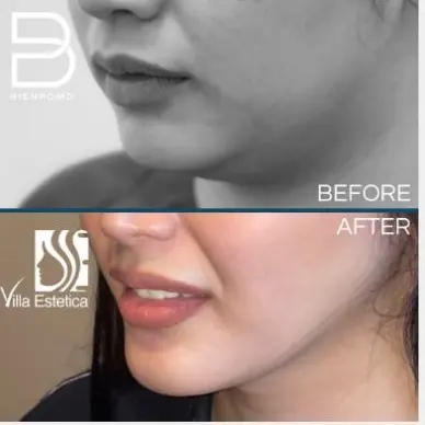 Liposuction before and after patient result