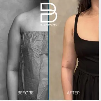Liposuction before and after patient result