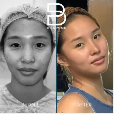 Rhinoplasty before and after patient result