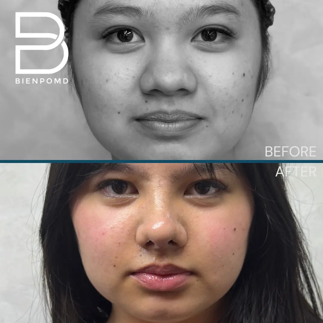 Open rhinoplasty before and one-week-after comparison, view 1