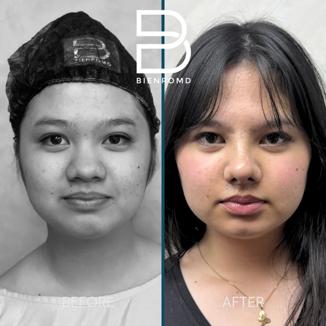 Open rhinoplasty before and one-week-after comparison, view 2