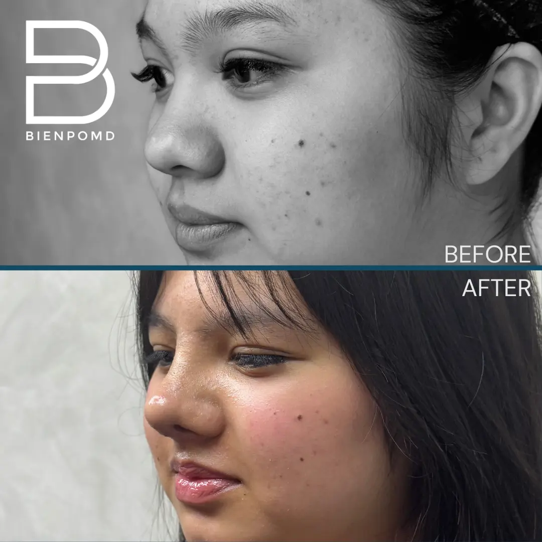 Open rhinoplasty before and one-week-after comparison, view 3