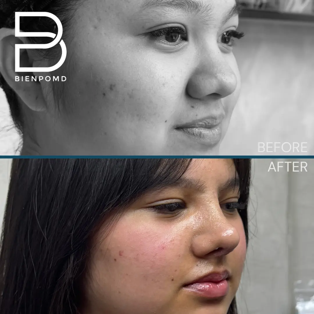 Open rhinoplasty before and one-week-after comparison, view 4
