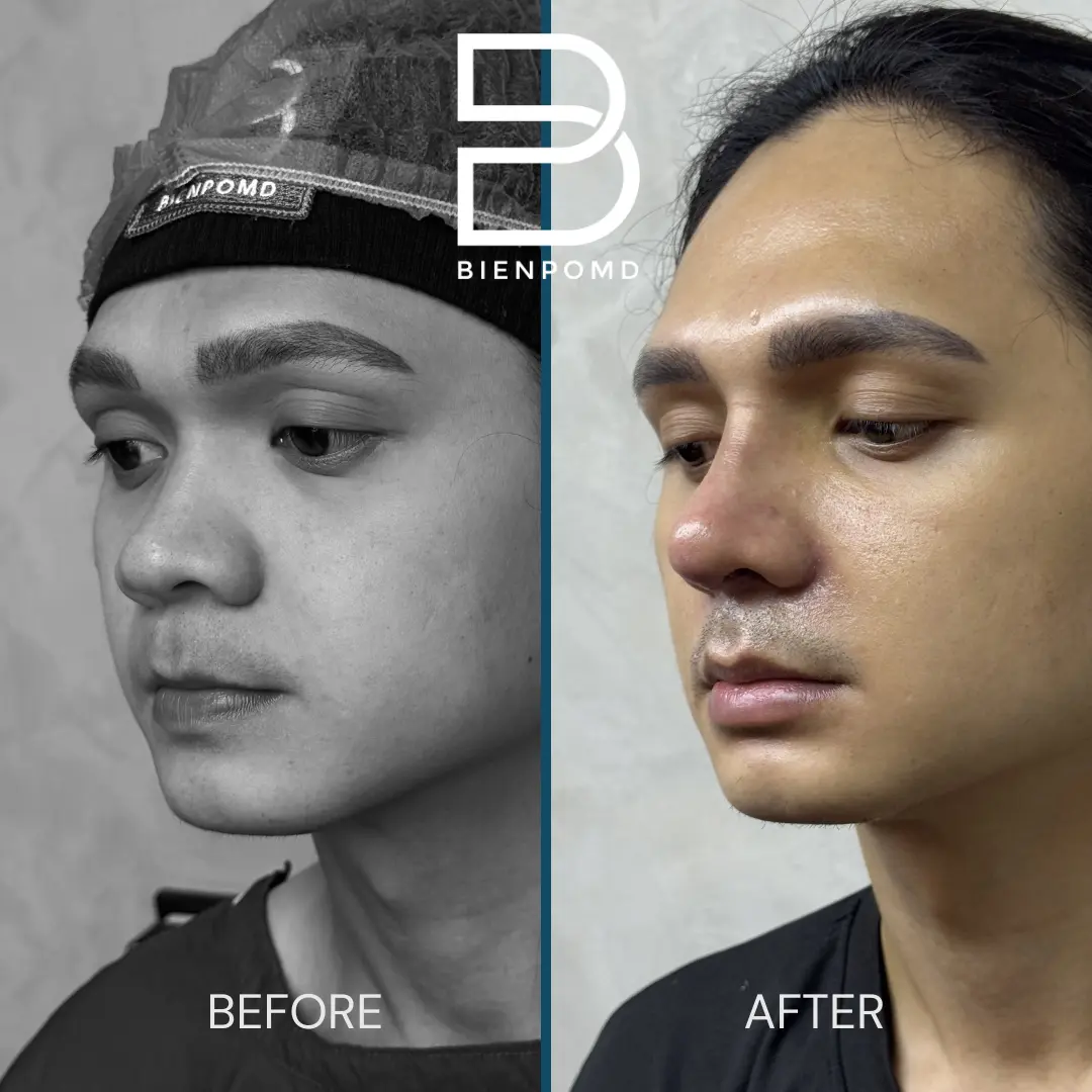Rhinoplasty before and after patient result
