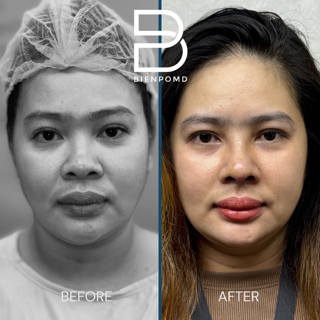 Front view before and one week after rhinoplasty using acellular dermal matrix, irradiated rib cartilage, and ear cartilage tipplasty
