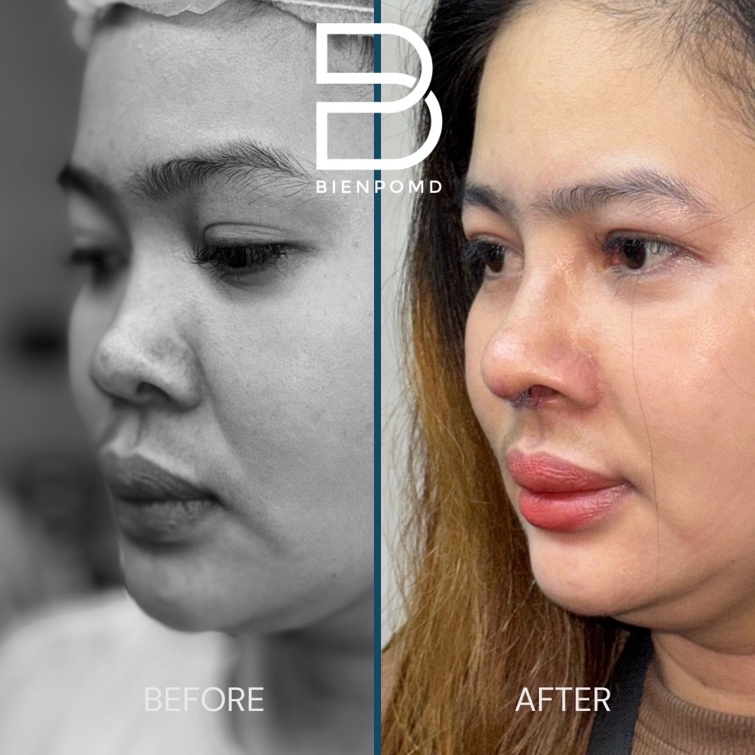 Left oblique view before and one week after rhinoplasty using acellular dermal matrix, irradiated rib cartilage, and ear cartilage tipplasty