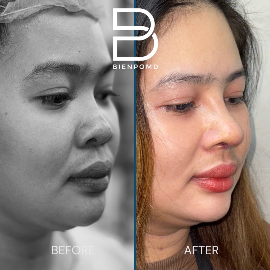 Right oblique view before and one week after rhinoplasty using acellular dermal matrix, irradiated rib cartilage, and ear cartilage tipplasty