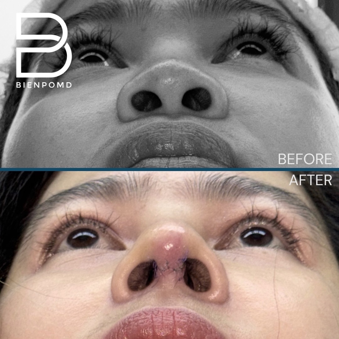 Basal view before and one week after rhinoplasty using acellular dermal matrix, irradiated rib cartilage, and ear cartilage tipplasty