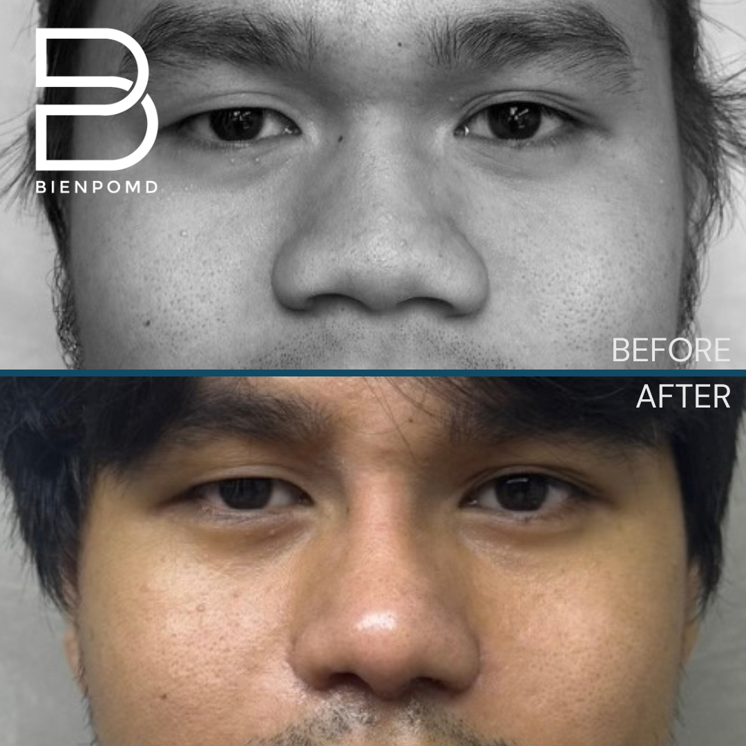 Before and 2 weeks after Gore-Tex (ePTFE) rhinoplasty, tipplasty using ear and irradiated rib cartilage, and alarplasty — view 1. This is an early healing result; individual results vary.