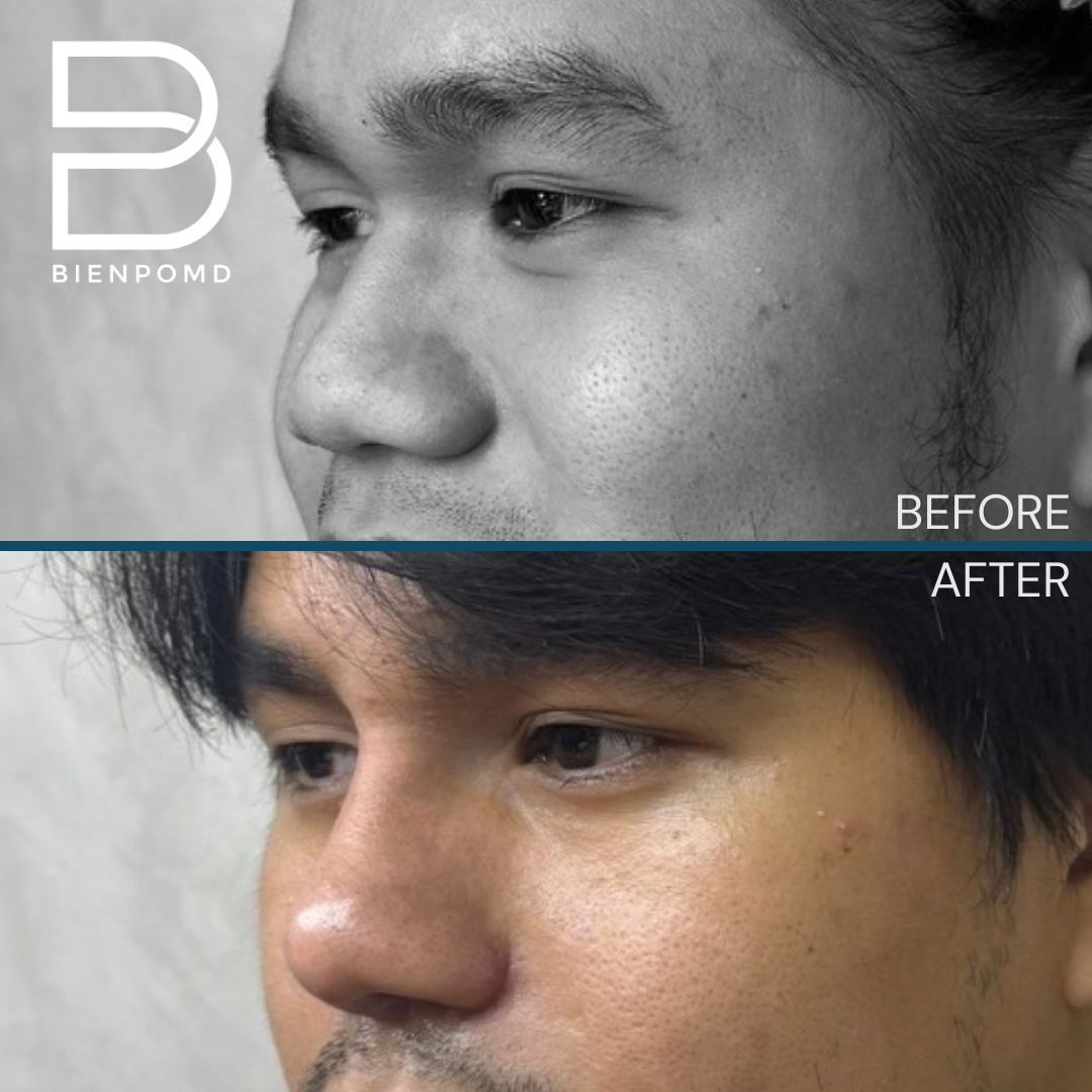 Before and 2 weeks after Gore-Tex (ePTFE) rhinoplasty, tipplasty using ear and irradiated rib cartilage, and alarplasty — view 2. This is an early healing result; individual results vary.